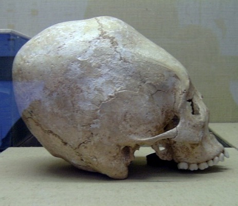 Так называемый череп аварской принцессы из местечка Ваценовичи, Моравия, 7 век