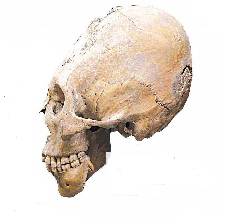 Гуннский деформированный череп из Национального музея Будапешта.